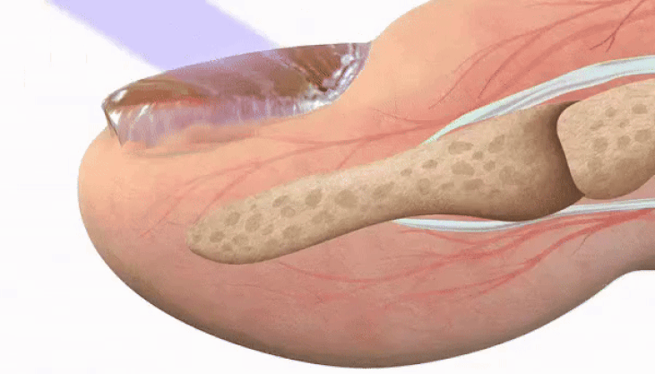 CONCLUSION: Kinzenio Light Wipes Out Fungus Unlike Anything Else We’ve Seen
